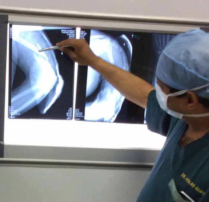 First who used AO locking plates